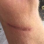 Rope Burn from Sail Handling: How It Happens