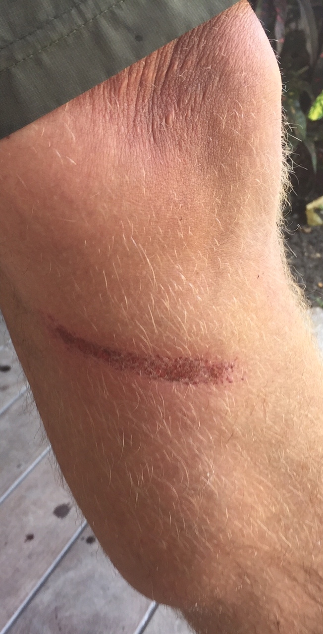It’s just a flesh wound: when sail handling goes wrong