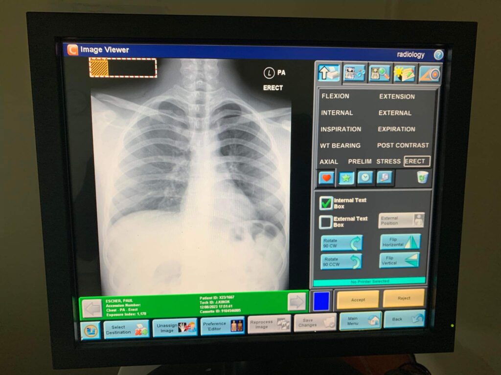 Paul's chest X-ray showed that he had water in his left lung.